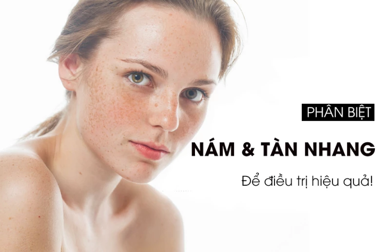 Nám da và Tàn nhang: Cách phân biệt và giải pháp điều trị